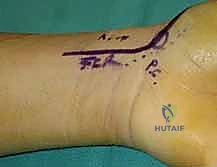 التشوه المحدب في العظم الزورقي وتأثيره على المفصل