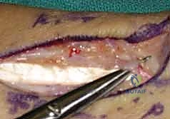 فحص بالأشعة يوضح عدم التئام الكسر والفجوة العظمية