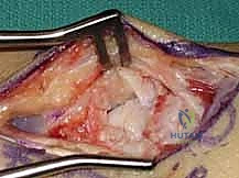 التخطيط الجراحي الدقيق وتحديد زوايا العظم قبل العملية