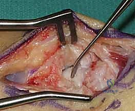 النهج الجراحي الأمامي للوصول إلى العظم الزورقي بأمان