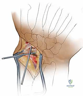 استخدام أسلاك التوجيه الدقيقة قبل وضع المسمار الضاغط