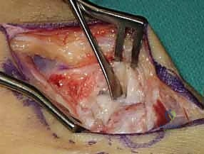 أخذ الرقعة العظمية وتجهيزها بشكل وتدي دقيق