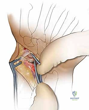 وضع الرقعة العظمية الوتدية في الفجوة لتصحيح التشوه