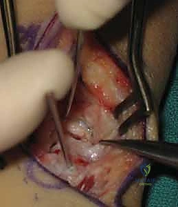 إدخال مسمار الضغط بدون رأس لتثبيت الرقعة والعظم بإحكام