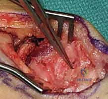 صورة توضيحية لـ علاج عدم التئام العظم الزورقي بالرسغ: ترقيع العظم وتثبيت داخلي مع الأستاذ الدكتور محمد هطيف