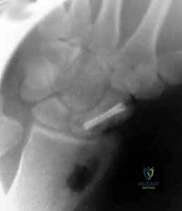 علاج عدم التئام العظم الزورقي بالرسغ: ترقيع العظم وتثبيت داخلي مع الأستاذ الدكتور محمد هطيف