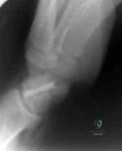 Illustration of bone grafting and internal - Dr. Mohammed Hutaif