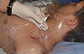 التخدير الناحي باستخدام الموجات فوق الصوتية