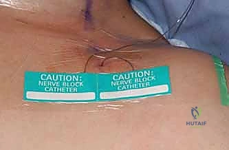 إبرة التخدير الموضعي وتوجيهها بدقة