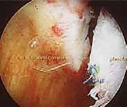 صورة توضيحية لـ إصلاح بانكارت بالمنظار: حل متقدم لعدم استقرار الكتف الأمامي وخلعه المتكرر مع الأستاذ الدكتور محمد هطيف