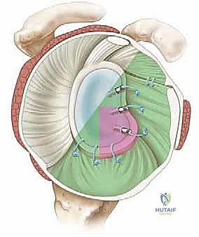صورة توضيحية لـ إصلاح بانكارت بالمنظار: حل متقدم لعدم استقرار الكتف الأمامي وخلعه المتكرر مع الأستاذ الدكتور محمد هطيف
