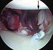 إصلاح بانكارت بالمنظار: حل متقدم لعدم استقرار الكتف الأمامي وخلعه المتكرر مع الأستاذ الدكتور محمد هطيف