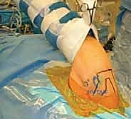 تشريح مفصل الكتف والشفا الحقاني