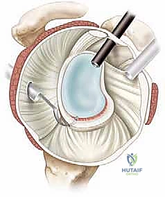 صورة توضيحية لـ إصلاح بانكارت بالمنظار: حل متقدم لعدم استقرار الكتف الأمامي وخلعه المتكرر مع الأستاذ الدكتور محمد هطيف
