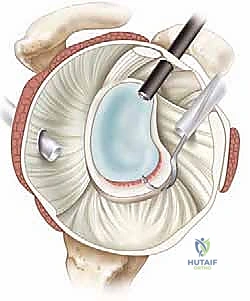 صورة توضيحية لـ إصلاح بانكارت بالمنظار: حل متقدم لعدم استقرار الكتف الأمامي وخلعه المتكرر مع الأستاذ الدكتور محمد هطيف