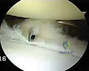 آفة بانكارت العظمية وتآكل التجويف الحقاني