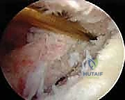 وضع المريض وتجهيزه لعملية منظار الكتف