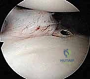 الأشعة المقطعية لتقييم الفقدان العظمي