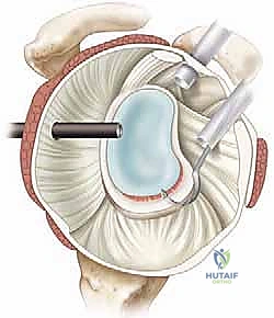صورة توضيحية لـ إصلاح بانكارت بالمنظار: حل متقدم لعدم استقرار الكتف الأمامي وخلعه المتكرر مع الأستاذ الدكتور محمد هطيف