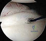 تصوير الرنين المغناطيسي لمفصل الكتف