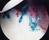 صورة طبية: إصلاح بانكارت بالمنظار: حل متقدم لعدم استقرار الكتف الأمامي وخلعه المتكرر مع الأستاذ الدكتور محمد هطيف