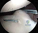 صورة طبية: إصلاح بانكارت بالمنظار: حل متقدم لعدم استقرار الكتف الأمامي وخلعه المتكرر مع الأستاذ الدكتور محمد هطيف