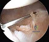 آفة بانكارت وتمزق الشفا الحقاني