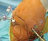 صورة توضيحية لـ إصلاح بانكارت بالمنظار: حل متقدم لعدم استقرار الكتف الأمامي وخلعه المتكرر مع الأستاذ الدكتور محمد هطيف