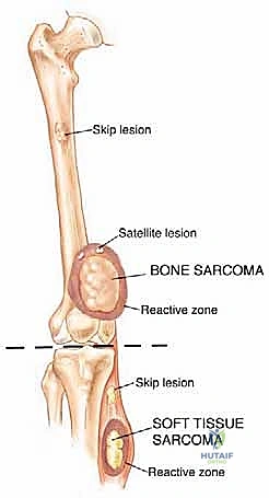 تشريح الجهاز العضلي الهيكلي والأورام