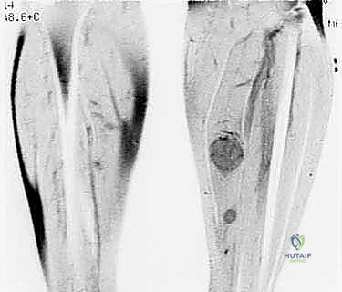 الفحص السريري للكتل والتورمات