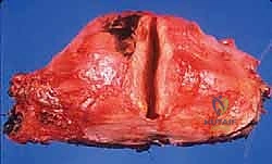 الفرق بين الأورام الحميدة والخبيثة في العظام