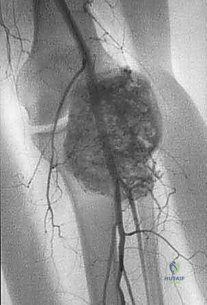 ألم العظام المستمر كعلامة تحذيرية