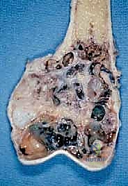 صورة توضيحية لـ فهم خزعة أورام الجهاز العضلي الهيكلي: دليل شامل للمرضى مع الأستاذ الدكتور محمد هطيف