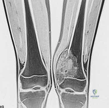 خزعة الإبرة الأساسية للورم