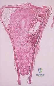 مخاطر الخزعة غير الدقيقة