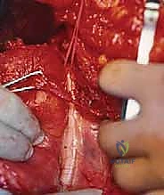 التخطيط متعدد التخصصات قبل الخزعة