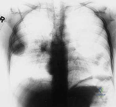 الكسور المرضية الناتجة عن الأورام