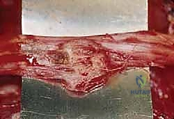 التصوير بالرنين المغناطيسي لأورام العظام