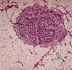 إدخال إبرة الخزعة بدقة متناهية