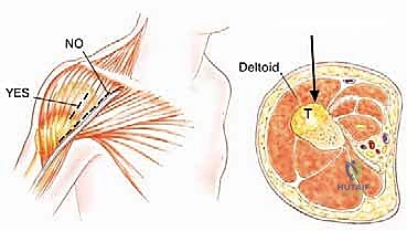 حفظ العينة في محلول الفورمالين