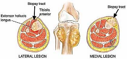 دقة الجراحة الميكروسكوبية في أخذ العينات