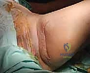 صورة توضيحية لـ فهم خزعة أورام الجهاز العضلي الهيكلي: دليل شامل للمرضى مع الأستاذ الدكتور محمد هطيف