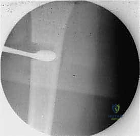 استخدام العكازات لحماية الطرف المصاب