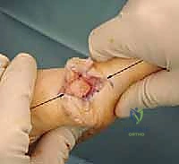 Mastering the Distal Chevron Osteotomy: An Intraoperative Guide for Hallux Valgus Correction