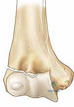 تورم الكوع بعد الإصابة بكسر اللقيمة الوحشية