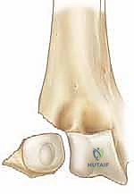 تصنيف درجات كسر اللقيمة الوحشية