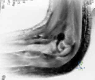 صورة توضيحية لـ كسر اللقيمة الوحشية للعضد عند الأطفال: دليل شامل للآباء والعلاج المتخصص في صنعاء