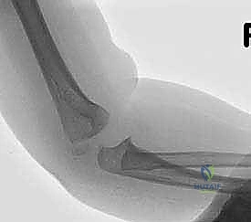 تصوير الأشعة السينية لتشخيص كسر اللقيمة الوحشية