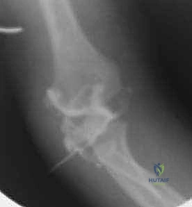 صورة توضيحية لـ كسر اللقيمة الوحشية للعضد عند الأطفال: دليل شامل للآباء والعلاج المتخصص في صنعاء