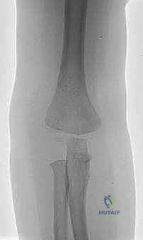 مقارنة بين خيارات العلاج لكسور الكوع